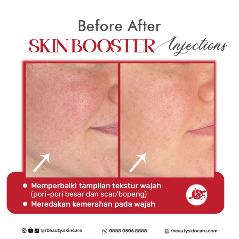 05 08 BEFORE AFTER SKIN BOOSTER