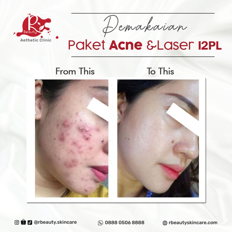 06 01 BA LASER I2PL + PRODUCT