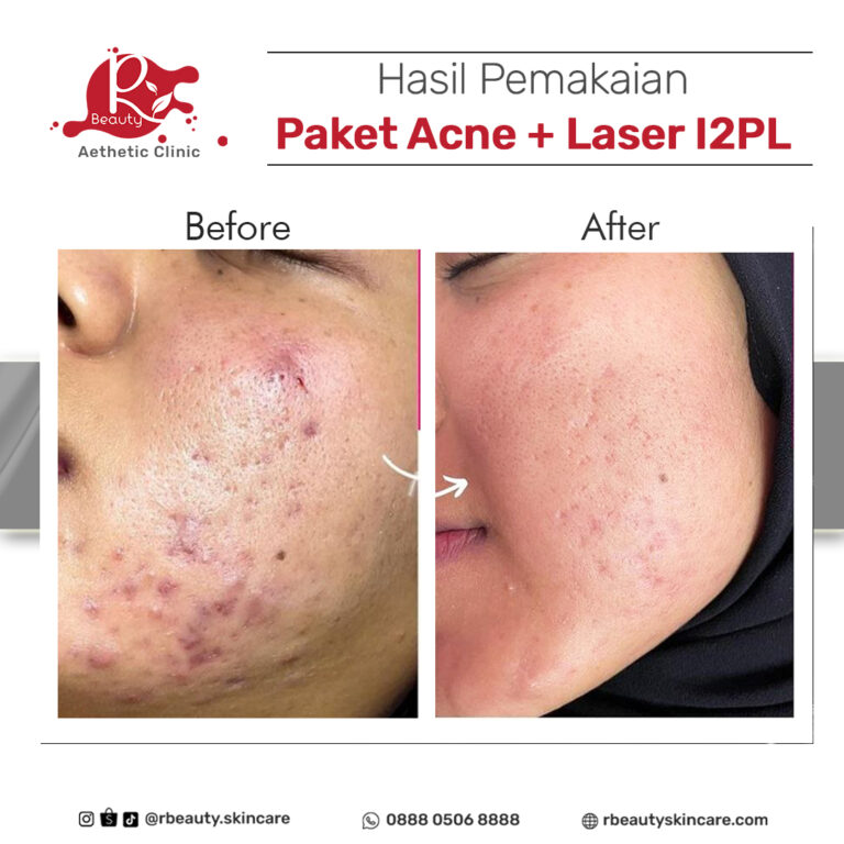 07 07 Before paket acne dan fc acne dan laser i2pl