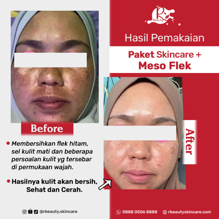 07 08 BEFORE AFTER MESO FLELK