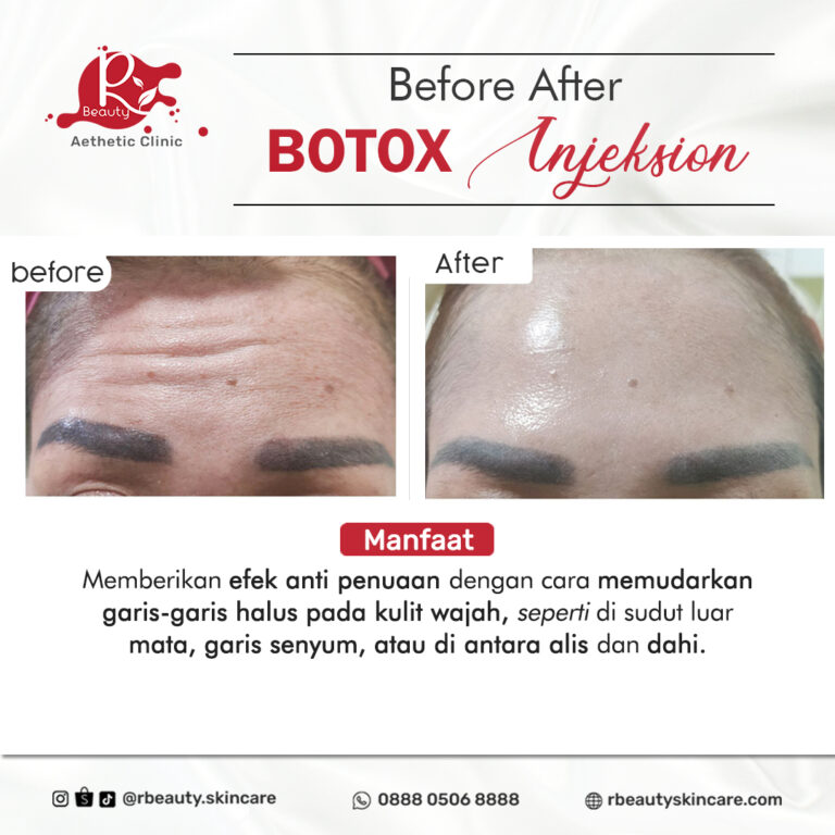 08 01 BA BOTOX
