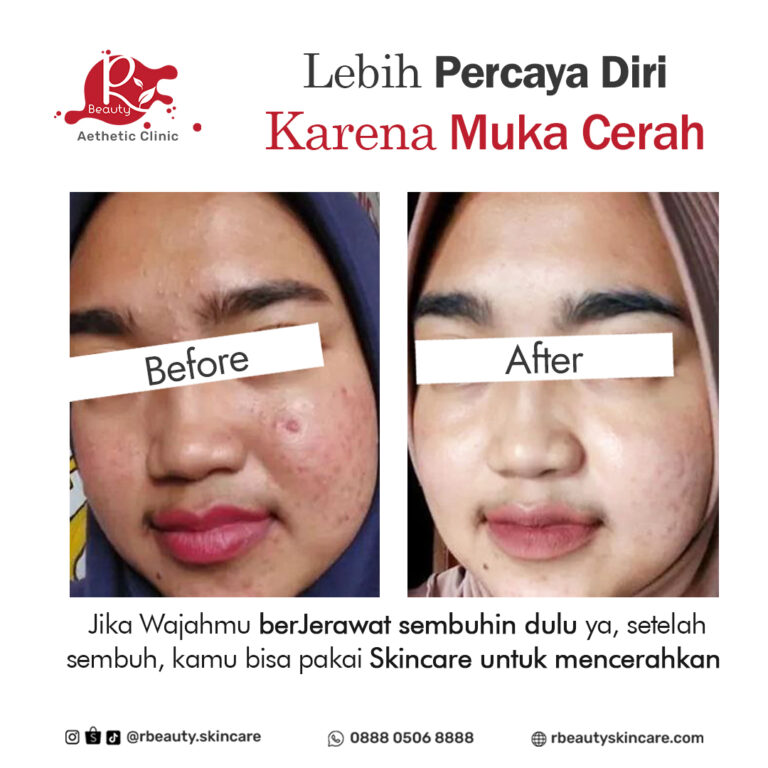 08 12 BA skincare acne