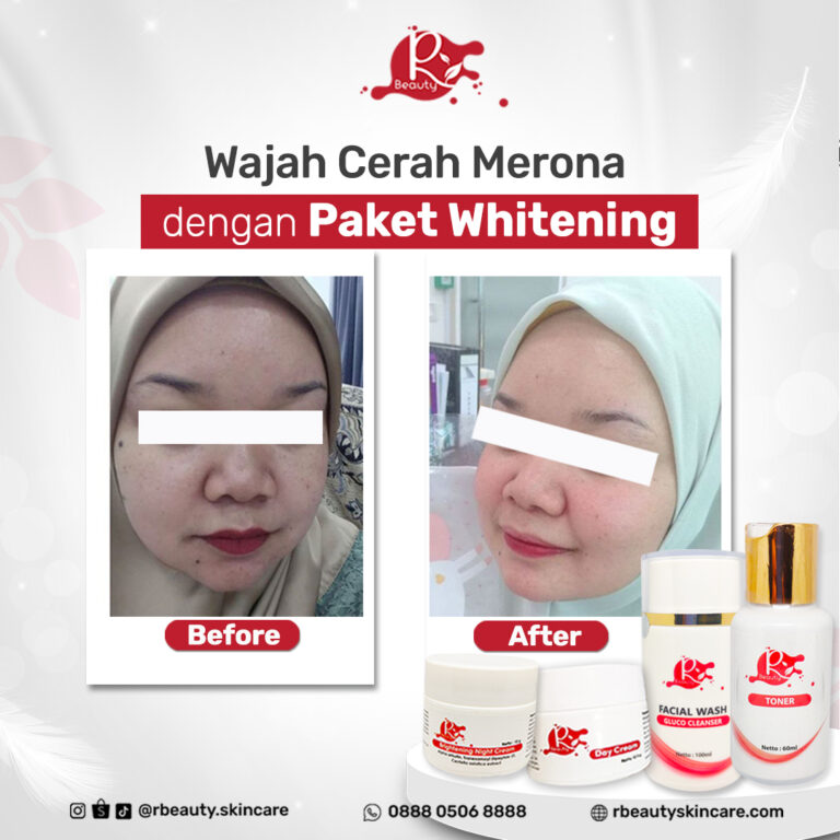 09 06 BEFORE AFTER PAKET WHITENING