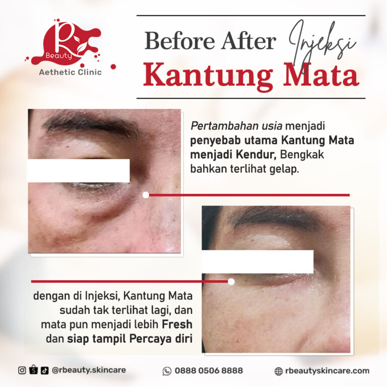 11 01 BA INJEKSI KANTUNG MATA