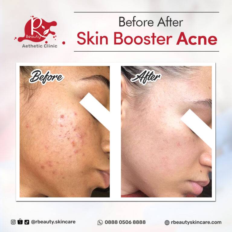11 01 BA SKIN BOOSTER
