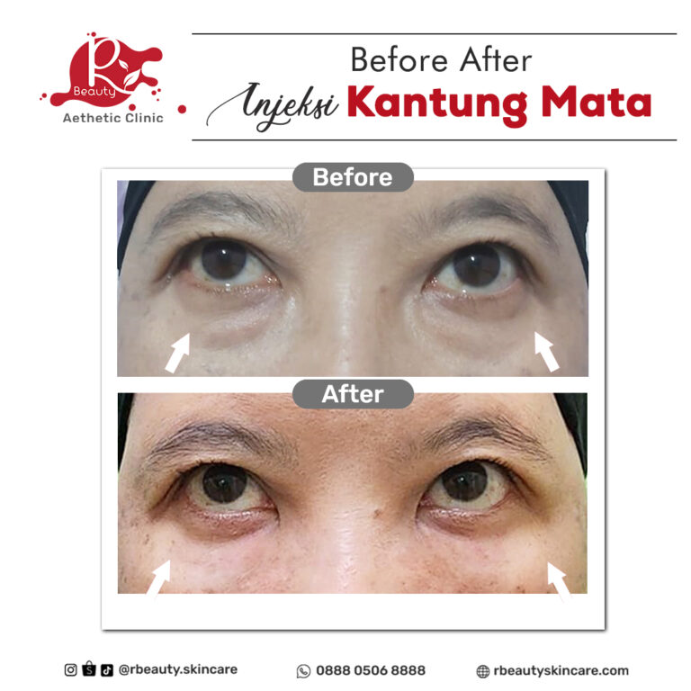 14 07 BEFORE AFTER INJEKSI KANTUNG MATA