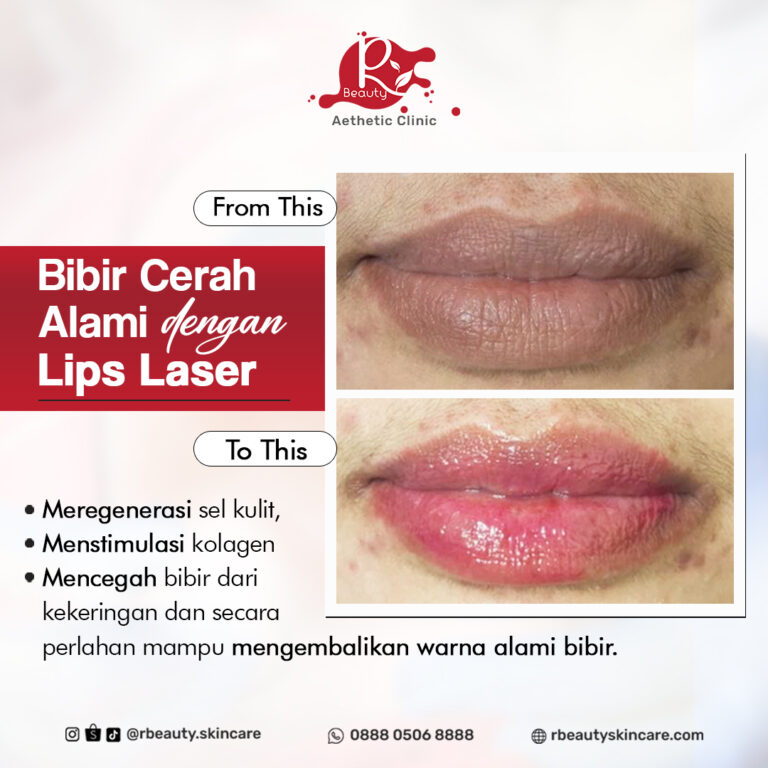 14 12 BA LIPS LASER