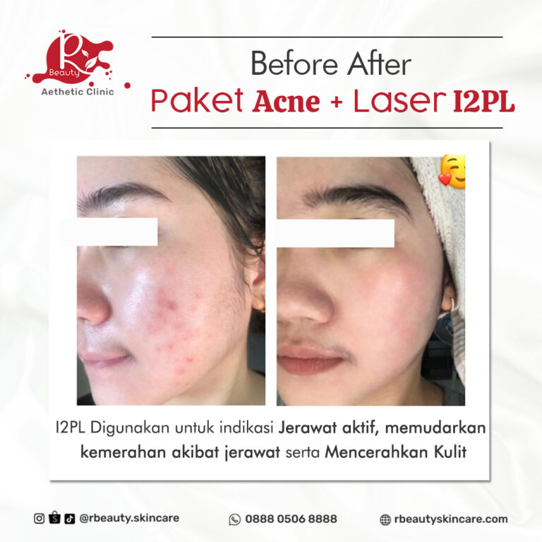 15 01 BA ACNE