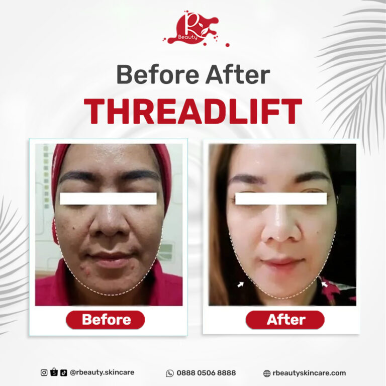 15 05 BEFORE AFTER THREADLIFT