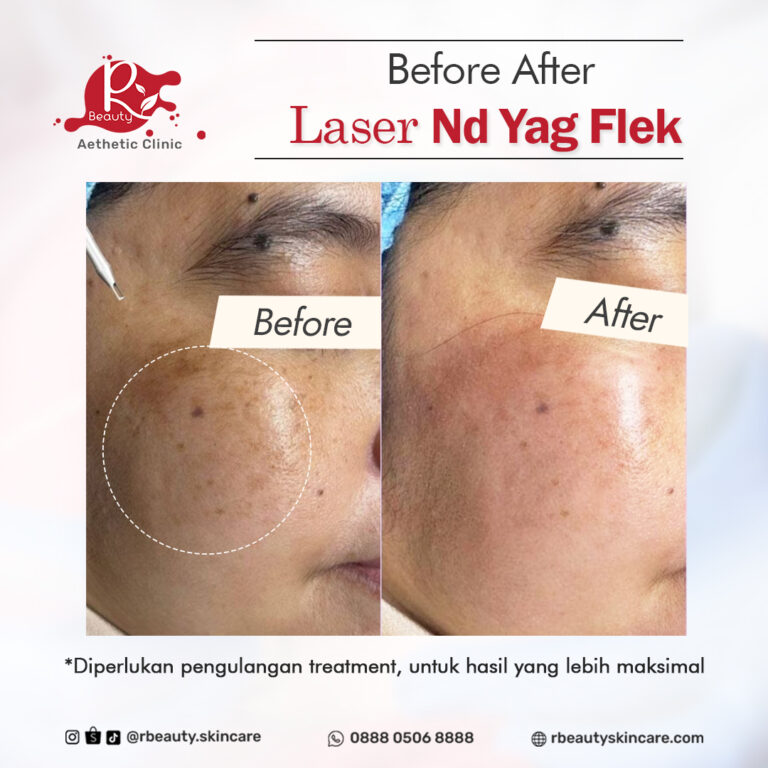 18 12 LASER ND YAG FLEK