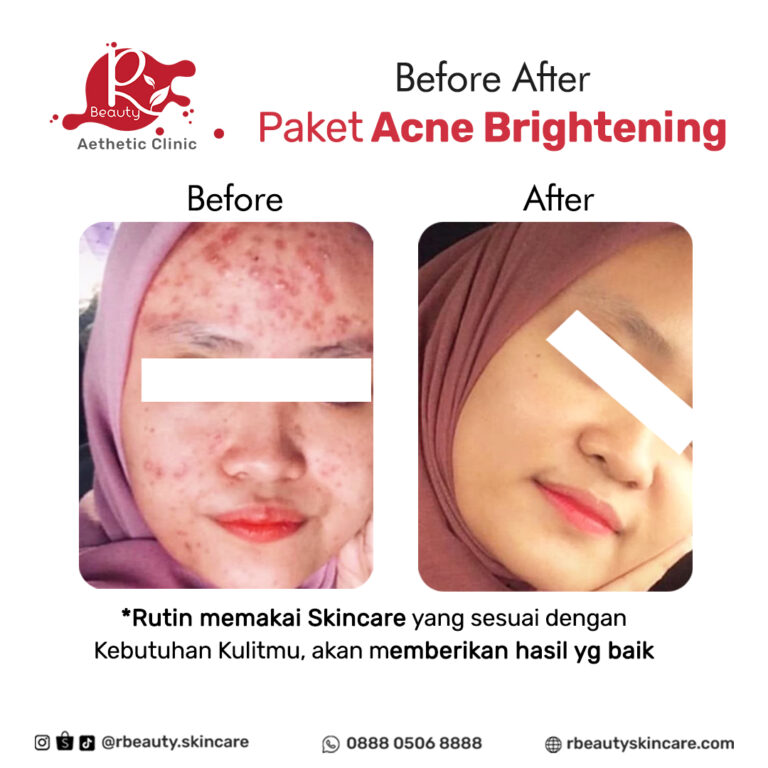 22 05 BEFORE AFTER JERAWAT