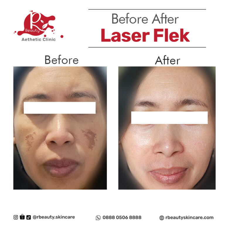 24 07 BEFORE AFTER MESO FLEK 02