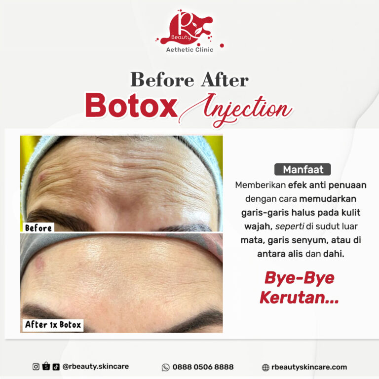 30 11 BA BOTOX