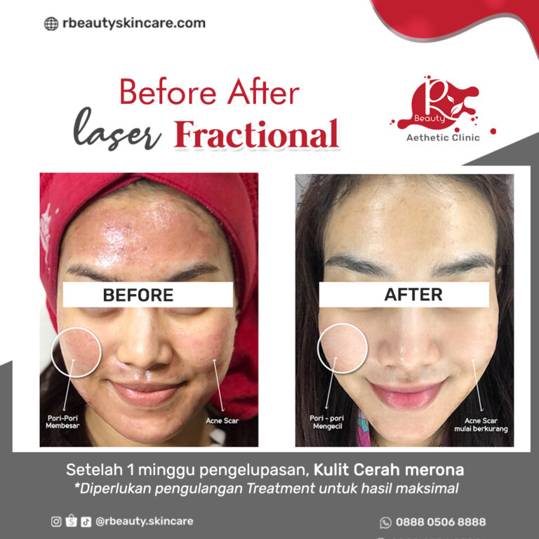 BA LASER FRACTIONAL